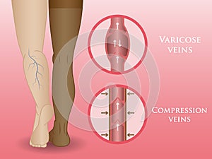 Medical compression hosiery