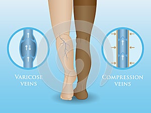 Medical compression hosiery