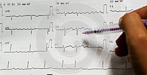 Medical concept, doctor looking ecg paper report of the patient in emergency room in hospital that showing normal sinus rhythm.