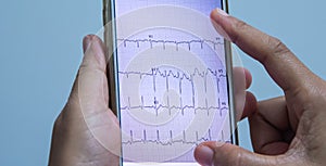 Medical concept, doctor looking ECG of the patient in smartphone that showing tachycardia rhythm of heart disease.