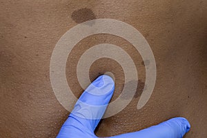 Medical dermatologist examines benign moles in African patient