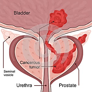 Medical diagram of 4 stage of prostate cancer. tumor grows and penetrates into neighboring organs and tissues. photo