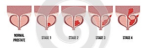Medical diagram of 4 stages of prostate cancer. tumor grows and penetrates into neighboring organs and tissues. photo