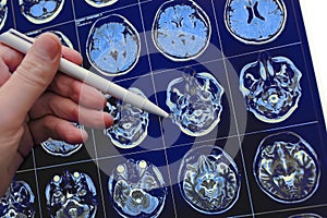 Medical doctor pointing with pen to the brain poblem on the MRI