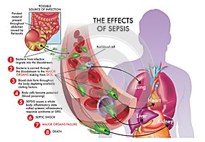 Medical effects of sepsis photo