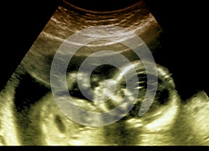 Medical Equipment ultrasound scanning. Diagnosis of pregnancy