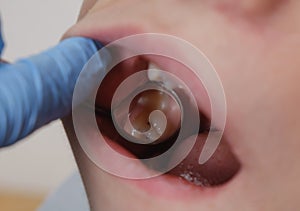 Medical examination of teeth using a mirror by a dentist. Caries, tooth damage.