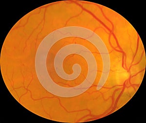 Medical Fundus photo of retinal pathology diabetic