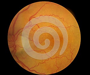 Medical Fundus photo of retinal pathology, hemmorhages, vein occlusion, macular degeneration photo