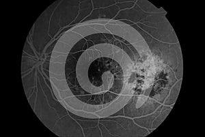 Medical Fundus photo of retinopathy