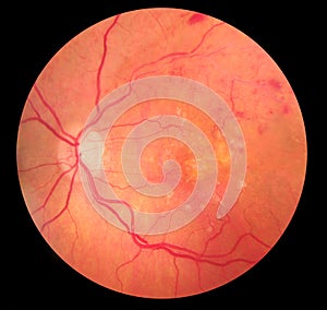 Medical Fundus photo of retinopathy hemorrhage photo