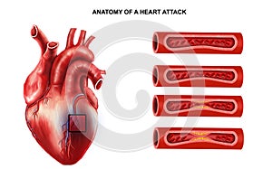 Medical illustration of Anatomy of Heart Attack