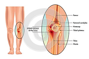 Medical illustration of bone edema on knee