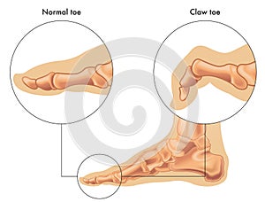 Medical Illustration Of Claw Toe 