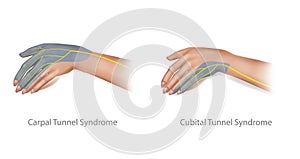 Medical illustration of the Cubital and Carpal Tunnel Syndrome. Compressed Median and Ulnar nerve.