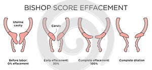 Medical illustration diagram - Bishop Score Effacement levels