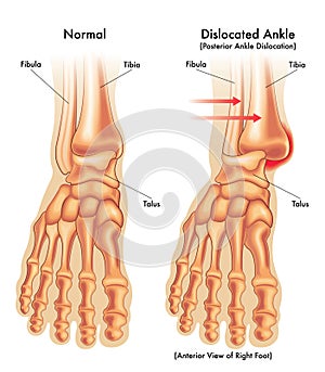 Medical illustration of dislocated ankle