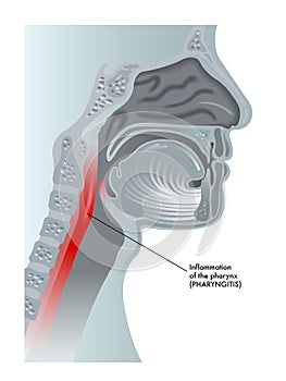 Pharyngitis