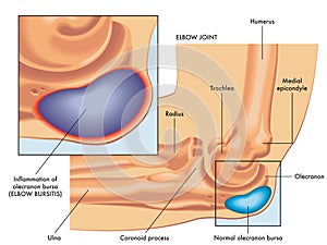 Medical Illustration Of Elbow Bursitis Symptoms 