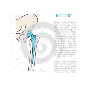 Medical illustration hip joint