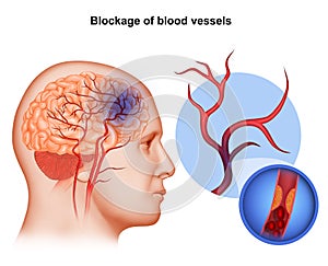 Medical illustration of Human Brain arteries blockage