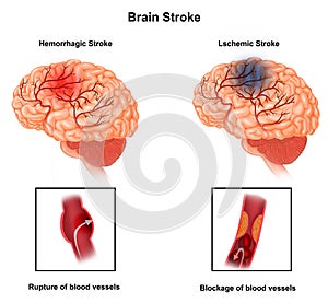 Medical illustration of Human Brain  arteries  blockage