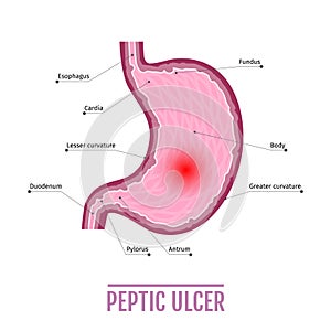 Medical illustration of the human stomach with peptic ulcer. scheme for textbooks