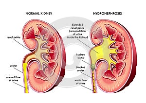 Medical illustration of kidney with hydronephrosis
