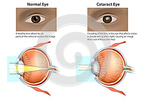 Medical illustration of a normal eye and an eye with a cataract, photo