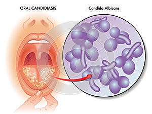 Medical illustration of oral candidiasis photo