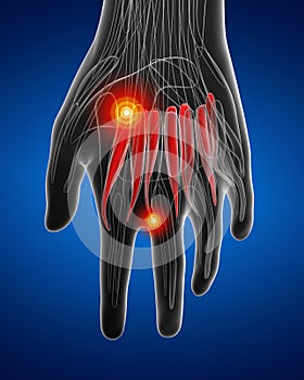 Medical  illustration of the palmar interosseous