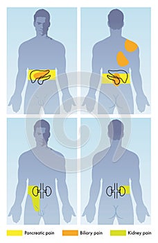 Medical illustration for pancreatic, biliary or kidney pain