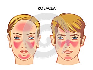Medical illustration of Rosacea on face