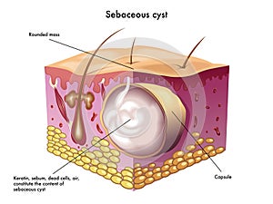 Sebaceous cyst