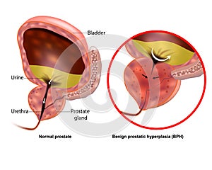 Medical illustration showing Benign prostatic hyperplasia BPH and Normal prostate. Prostate gland enlargement