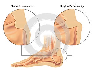 Medical Illustration Showing Haglund's Deformity