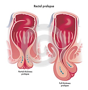 Medical illustration showing two types of rectal prolapse