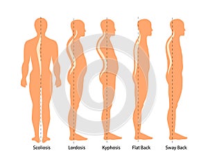 Medical illustration of spinal deformity types: scoliosis, lordosis and kyphosis, Sway back. Body posture defect