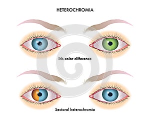 Heterochromia of the iris photo