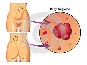 Ruby angioma