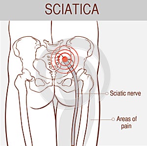 Medical illustration of symptoms of sciatica