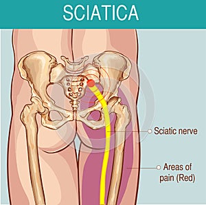 Medical illustration of symptoms of sciatica