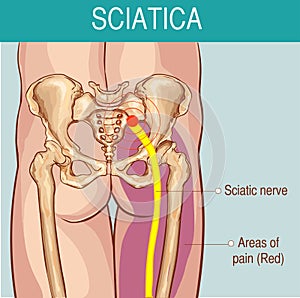 Medical illustration of symptoms of sciatica photo