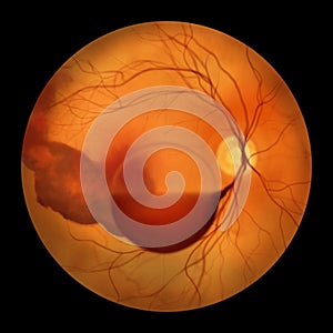 A medical illustration of Terson syndrome, revealing intraocular hemorrhage observed during ophthalmoscopy