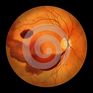 A medical illustration of Terson syndrome, revealing intraocular hemorrhage observed during ophthalmoscopy