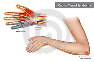 Medical illustration to explain Cubital tunnel syndrome. Ulnar nerve entrapment. Fascia involved in ulnar nerve photo