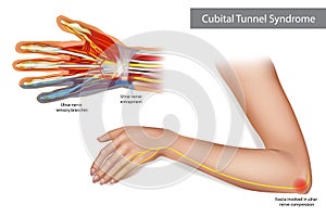 Medical illustration to explain Cubital tunnel syndrome. Ulnar nerve entrapment. Fascia involved in ulnar nerve