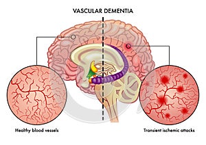 Medical illustration of vascular dementia photo