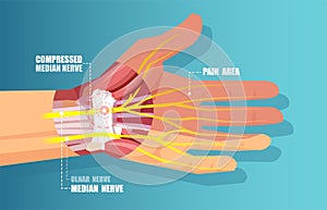 Vector of a carpal tunnel syndrome with median nerve compression photo