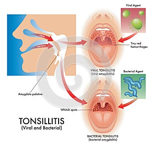 Medical Illustration Of Viral And Bacterial Tonsillitis 